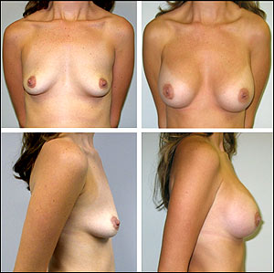Breast Augmentation Before and After